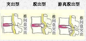 腰椎间盘突出类型.jpg